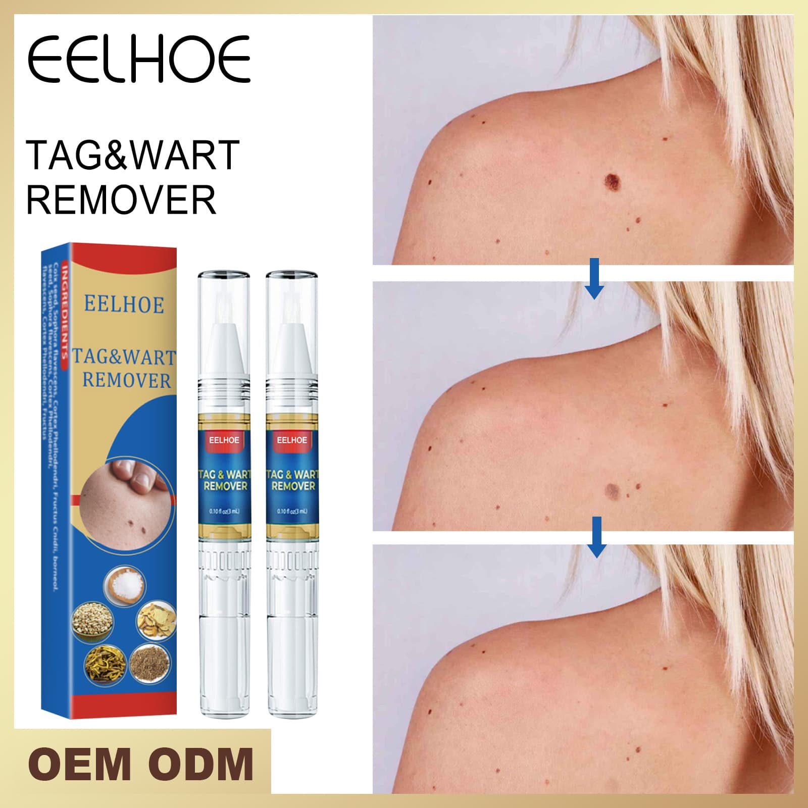 EELHOE Ke You liquid, body skin sharp warts, flesh thorns, warts pen, wart removal pen