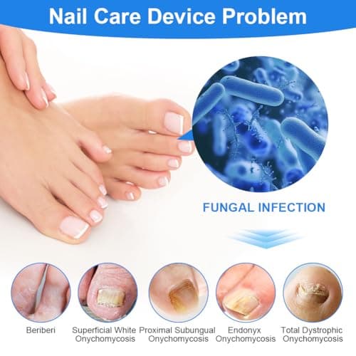 ACWOO Appareil Traitement Laser Mycose Ongles, Portable Dispositif des Champignons des Ongles, Dispositif de Traitement Laser pour Mycose Ongles des Pieds Nettoyage et Réparation Ongles Traitement