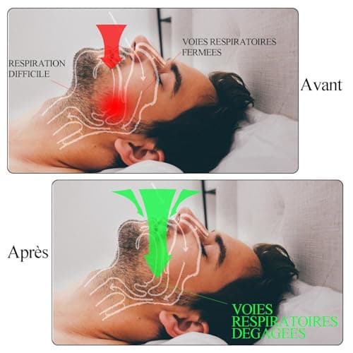 Appareil Dentaire Anti Ronflement,GouttièRe Dentaire+8dilatateur Nasal,Anti Ronflement Efficace,ProtèGe-Dents SûR,Inodore Et Doux,Sommeil Bruxisme,Agit Sur Les Causes D’Un Mauvais Sommeil