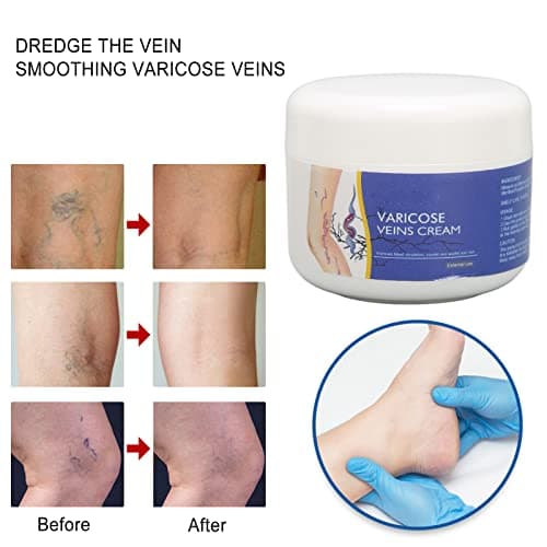 50g Crème De Traitement des Varices Crème Pour les Varices Ingrédients Naturels Hydrate la Crème Réparatrice des Varices Pour Améliorer L'apparence des Jambes