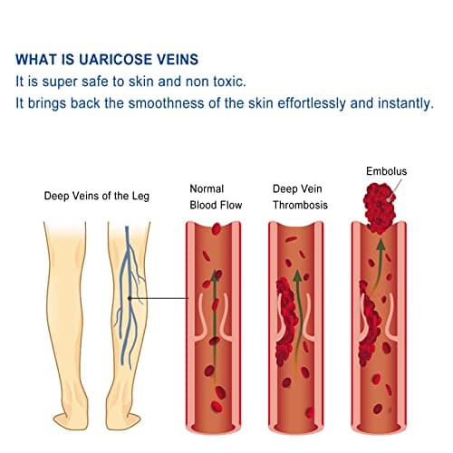 50g Crème De Traitement des Varices Crème Pour les Varices Ingrédients Naturels Hydrate la Crème Réparatrice des Varices Pour Améliorer L'apparence des Jambes