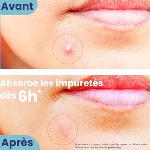 Patch Bouton Acné – Hydrocolloïdes – Pimple Patch Anti Bouton – Absorbe Les Impuretés dès 6h – Skincare Coréen, Ultra Fin – Favorise La Cicatrisation – Idéal Routine Skincare