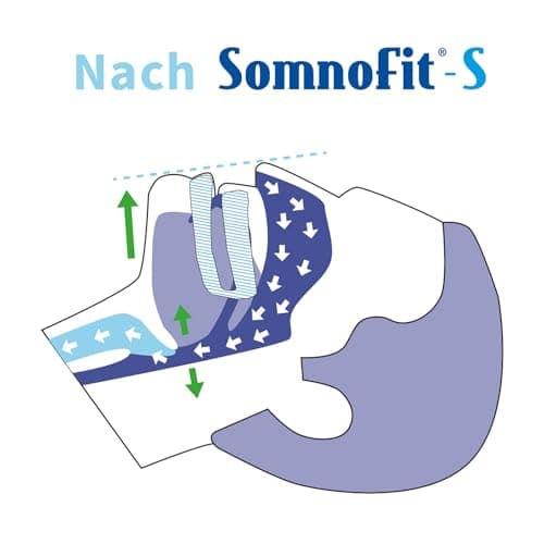 Oscimed Sa - Orthèse contre ronflement et apnée (Réglable) Somnofit S
