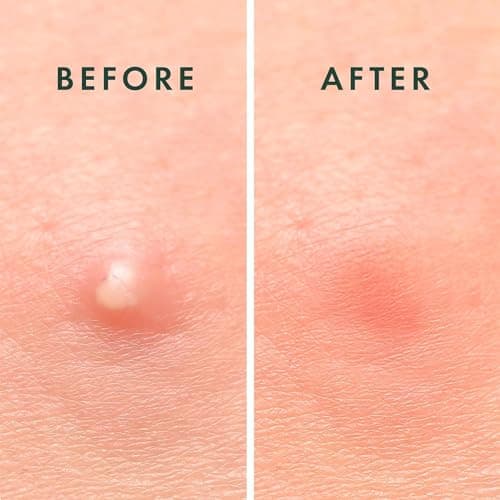 Rael Patch Anti Bouton Invisible - Pour Visage, Acne, Pimple Patches, Skincare Coreen, Hydrocolloïdes, Deux tailles (96 Patchs)