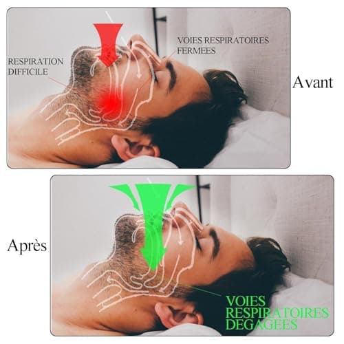 Appareil Dentaire Anti Ronflement,GouttièRe Dentaire+8dilatateur Nasal,Anti Ronflement Efficace,ProtèGe-Dents SûR,Inodore Et Doux,Sommeil Bruxisme,Agit Sur Les Causes D’Un Mauvais Sommeil-Translucide