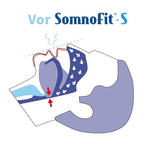 Oscimed Sa - Orthèse contre ronflement et apnée (Réglable) Somnofit S