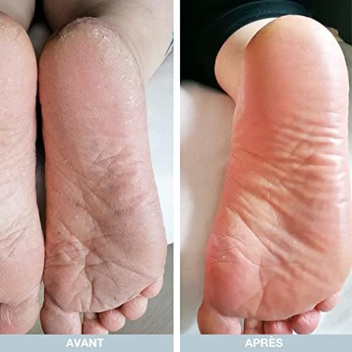 Kit de soins pour les pieds à l'huile d'arbre à thé : gel douche, crème et spray - Soulagement apaisant pour les athlètes, les coureurs et toute personne ayant besoin de soins - Formule hydratante