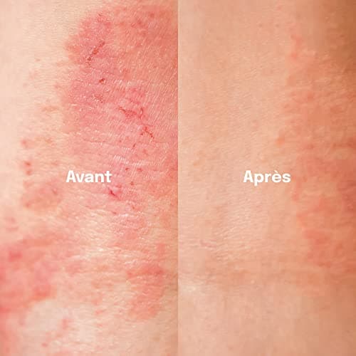 HEALR Spray pour l'Eczema, Psoriasis & Démangeaison Cutanée - 100ml - Enrichi d'Aloe Vera, Oméga 3 et Chlorure de Magnésium - Hydrate, Soulage et Apaise - Fabriqué en Allemagne