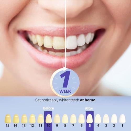 Ualans Kit Blanchiment Dentaire, Blanchiment des Dents Professionnel avec 32X Lamp Bleu et Rouge, 3 Gel Blanchissant, Gel Apaisant, Sans Sensibilité, Dents Blanches à Domicile en 10 Minutes