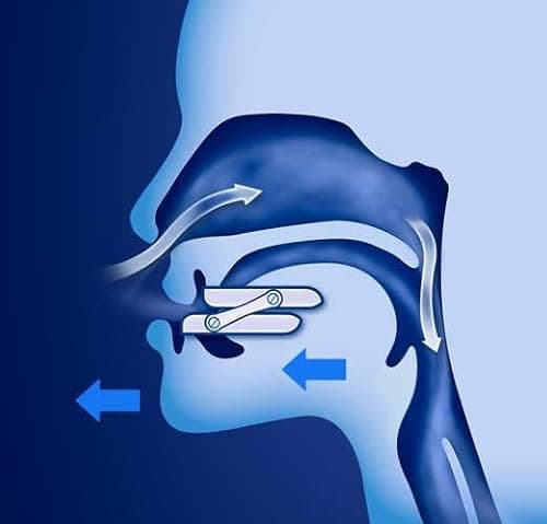 ONIRIS + Orthèse Anti Ronflement - Validé Cliniquement pour l Apnée Du Sommeil - Made in France - Gouttière dentaire - Orthèse d avancée Mandibulaire – Agit sur les causes d’un Mauvais Sommeil.