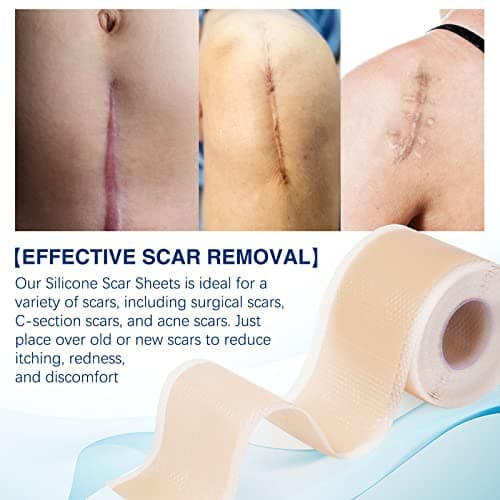 Feuilles de cicatrice en silicone (1,6"x130"-3,3M), bandes de ruban adhésif en silicone de qualité médicale pour incisions chirurgicales, césarienne, chéloïde, acné
