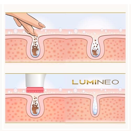 Lumineo brosse nettoyante pour le visage avec gel nettoyant, brosse électrique USB pour le visage pour un nettoyage en douceur et en profondeur (PRO rose (peau impure))