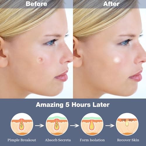 AMAINKI Patchs Boutons Hydrocolloïdes - Patches Anti-Acné pour le Visage, Absorbent les Impuretés, 2 Tailles (8mm/12mm), 252 Pièces, Enrichis en Huile d'Arbre à Thé.