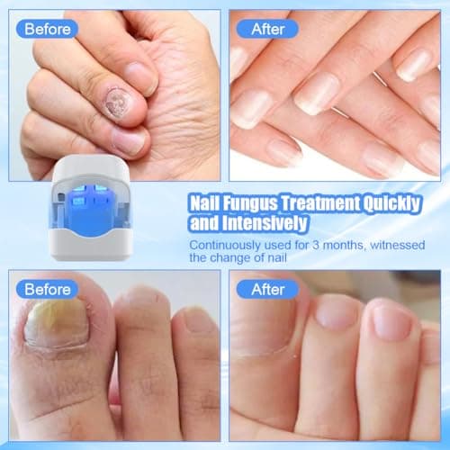 ACWOO Appareil Traitement Laser Mycose Ongles, Portable Dispositif des Champignons des Ongles, Dispositif de Traitement Laser pour Mycose Ongles des Pieds Nettoyage et Réparation Ongles Traitement