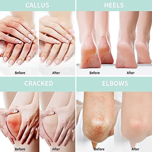Crème à l'Urée 40% avec plus de 2% d'Acide Salicylique | pour Pieds et mains | Acide hyaluronique, arbre à thé, aloe vera | Hydrate, élimine les callosités et adoucit | 150 g