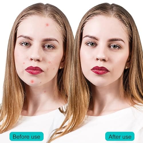 EUZUXU 40 Patchs Acné Patch, Pimple Patch, Patch Acne Pimple Anti-Acné Imperméable Autocollants Hydrocolloïde pour Boutons Invisible pour Soin de la Peau