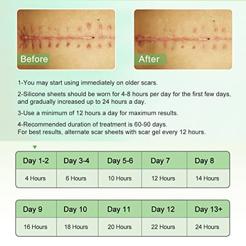 Feuilles de cicatrice en silicone (1,8 "x 120" -3M), bandes de ruban adhésif en silicone de qualité médicale pour incisions chirurgicales, césarienne, chéloïde, acné