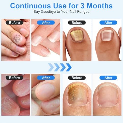 ACWOO Appareil Traitement Laser Mycose Ongles, Portable Dispositif des Champignons des Ongles, Dispositif de Traitement Laser pour Mycose Ongles des Pieds Nettoyage et Réparation Ongles Traitement
