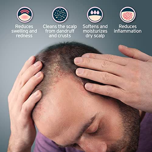 Sphagnum Botanicals Shampoing Contre La Dermatite Séborrhéique – Tourbe Pour Traitement Du Cuir Chevelu Sec, Prurigineux Et Floconneux. Aide Aussi À Traiter Pellicules, Psoriasis Et Eczéma. 400 ml