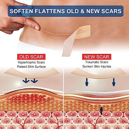 Feuilles de cicatrices en silicone - Rouleau de ruban adhésif en silicone de qualité médicale (4,1 x 300,5 cm) - Réutilisables - Feuilles d'élimination des cicatrices professionnelles pour césarienne