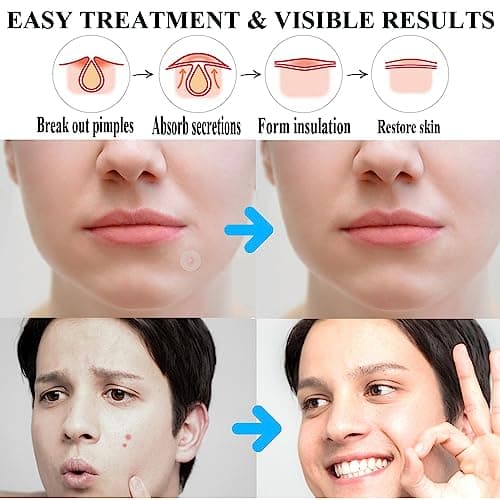 Zemolo 300PCS Patch Boutons Acne, Patch Acne Pimple Anti-Acné Imperméable Autocollants Hydrocolloïde pour Boutons Invisible pour Soin de la Peau