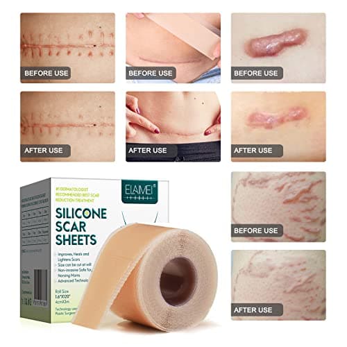 Feuilles de cicatrices en silicone - Rouleau de ruban adhésif en silicone de qualité médicale (4,1 x 300,5 cm) - Réutilisables - Feuilles d'élimination des cicatrices professionnelles pour césarienne