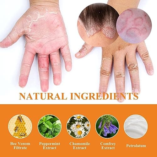 Crème Bee, Creme Psoriasis, Kaluofan 2PCS Youth d'abeille Psoriasis, Pierre Jaune Poudre Psoriasis, D'abeille,Crème D'abeille Crème de Psoriasis Bee