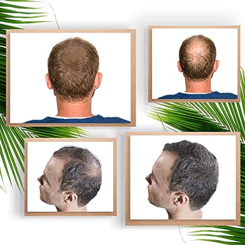 Poudre densifiante volumatrice pour cheveux - Calvitie, perte de cheveux & racines - Microfibres de kératine naturelle. Poudre capillaire Anti-Calvitie. Hair loss concealer I Châtain Foncé (30 gr) I