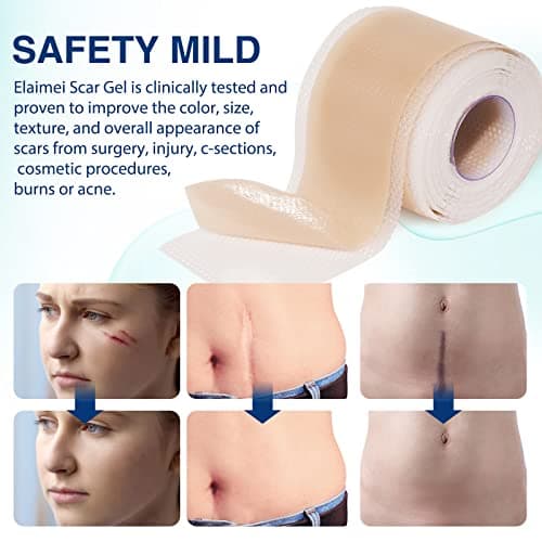 Feuilles de cicatrice en silicone (1,6"x130"-3,3M), bandes de ruban adhésif en silicone de qualité médicale pour incisions chirurgicales, césarienne, chéloïde, acné